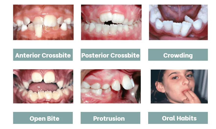 Examples of anterior crossbite, posterior crossbite, crowding, open bite, protrusion, and oral habits